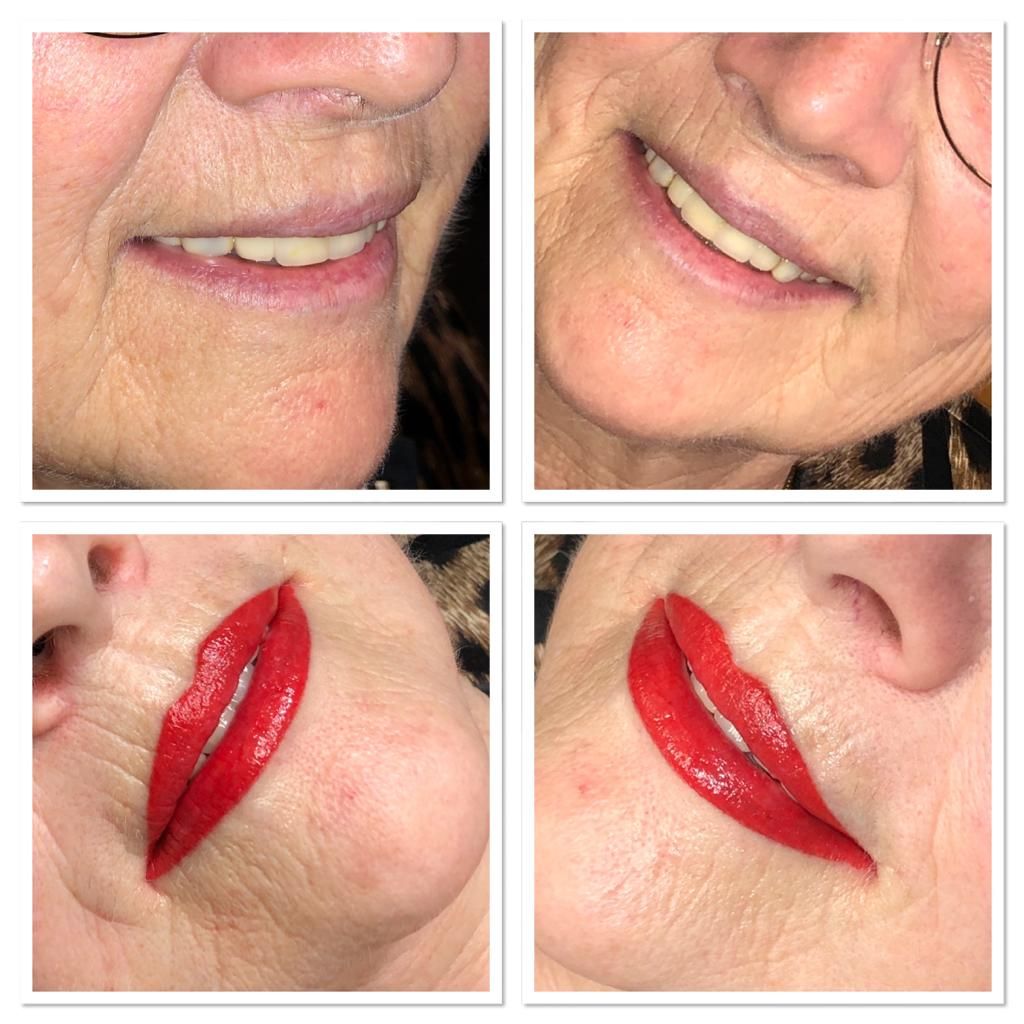 Resultaat permanente full lips