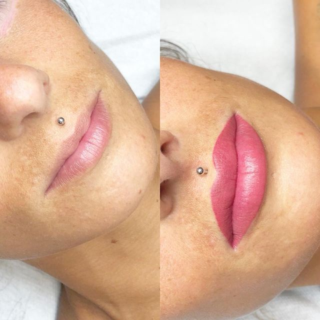 Permanente lip contour boven en onder