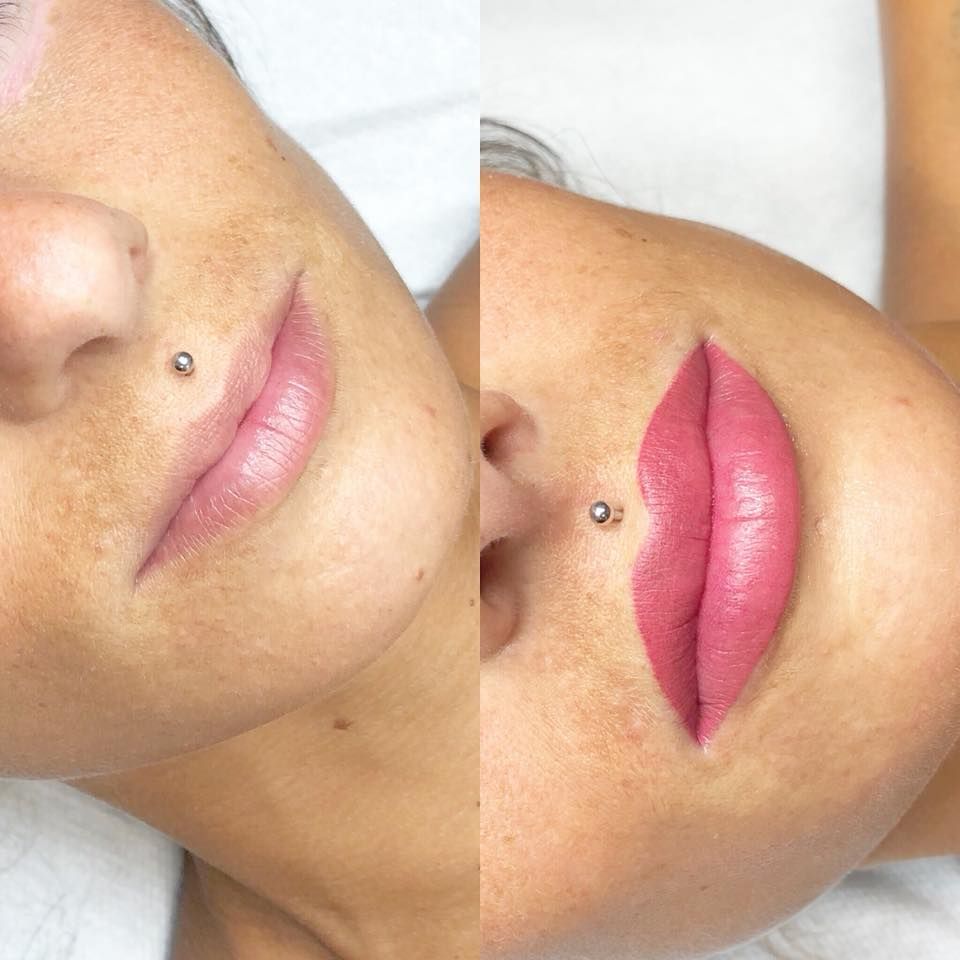 Permanente lip contour boven en onder