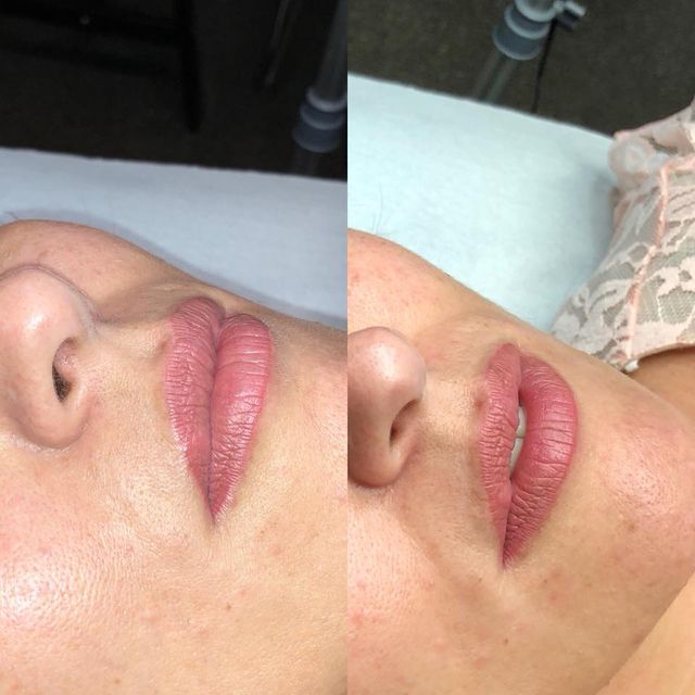Lip contour voor en na de behandeling