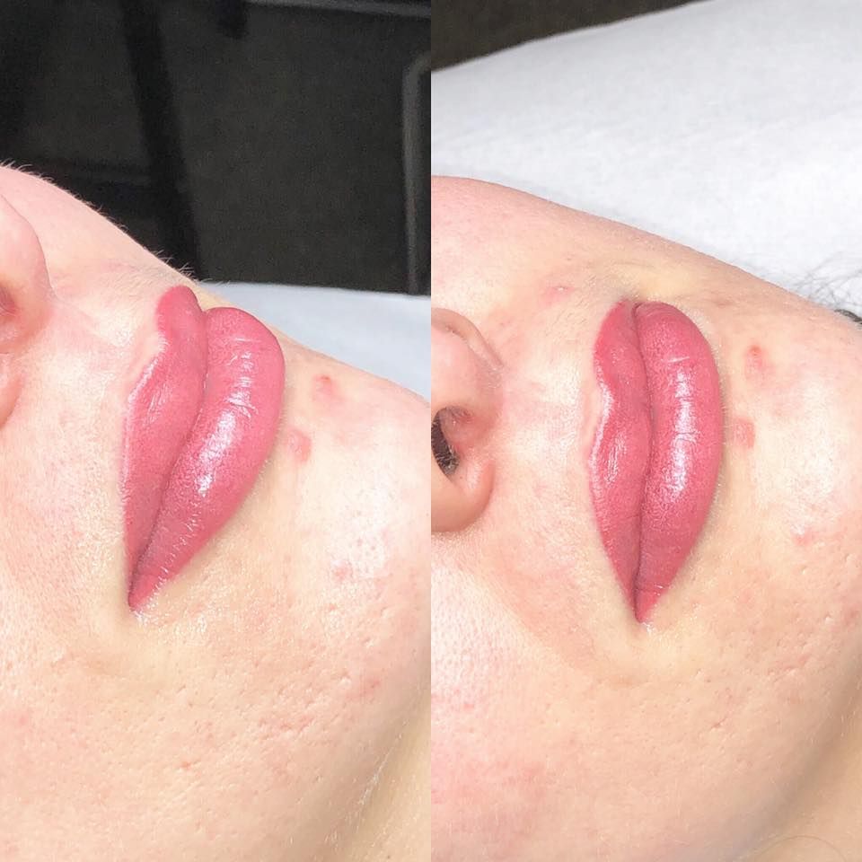 Permanente lip contour